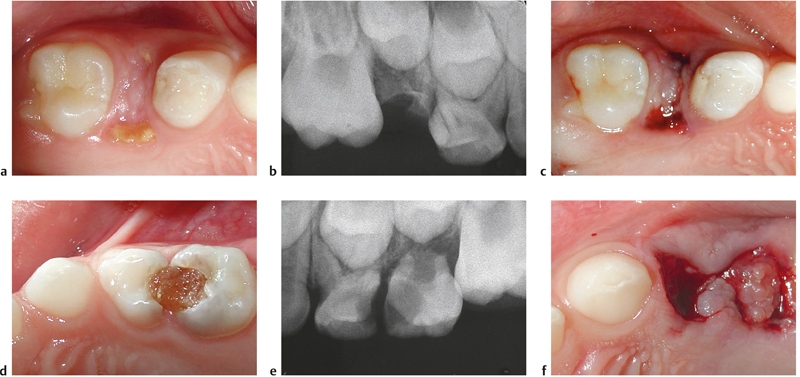 26 Minimal Interventional Treatment Of Caries In Young Children ...