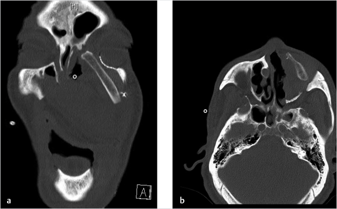 30 Reconstruction Of The Maxilla | Pocket Dentistry