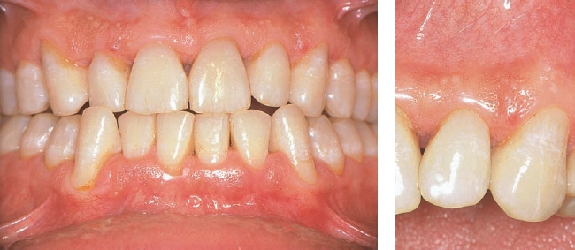 Necrotizing Ulcerative Gingivitis Before And After