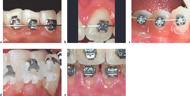 Practical Application Of Self-Ligating Brackets | Pocket Dentistry