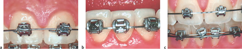 Practical Application Of Self-Ligating Brackets | Pocket Dentistry