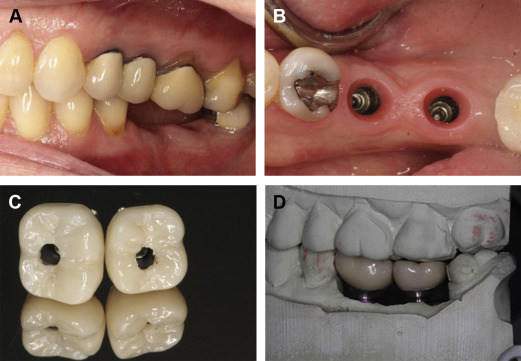 Management Of Implant/Prosthodontic Complications | Pocket Dentistry