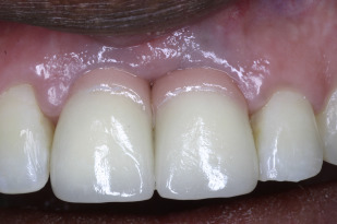 Prosthodontic Management Of Implant Therapy | Pocket Dentistry