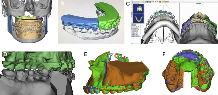 Evolving Management Of Dentofacial Deformities With Digital Planning ...