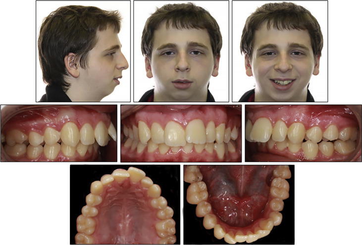 Orthodontic And Surgical Management Of A Patient With Severe Mandibular ...