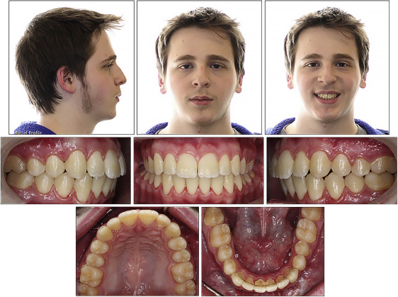 Orthodontic And Surgical Management Of A Patient With Severe Mandibular ...