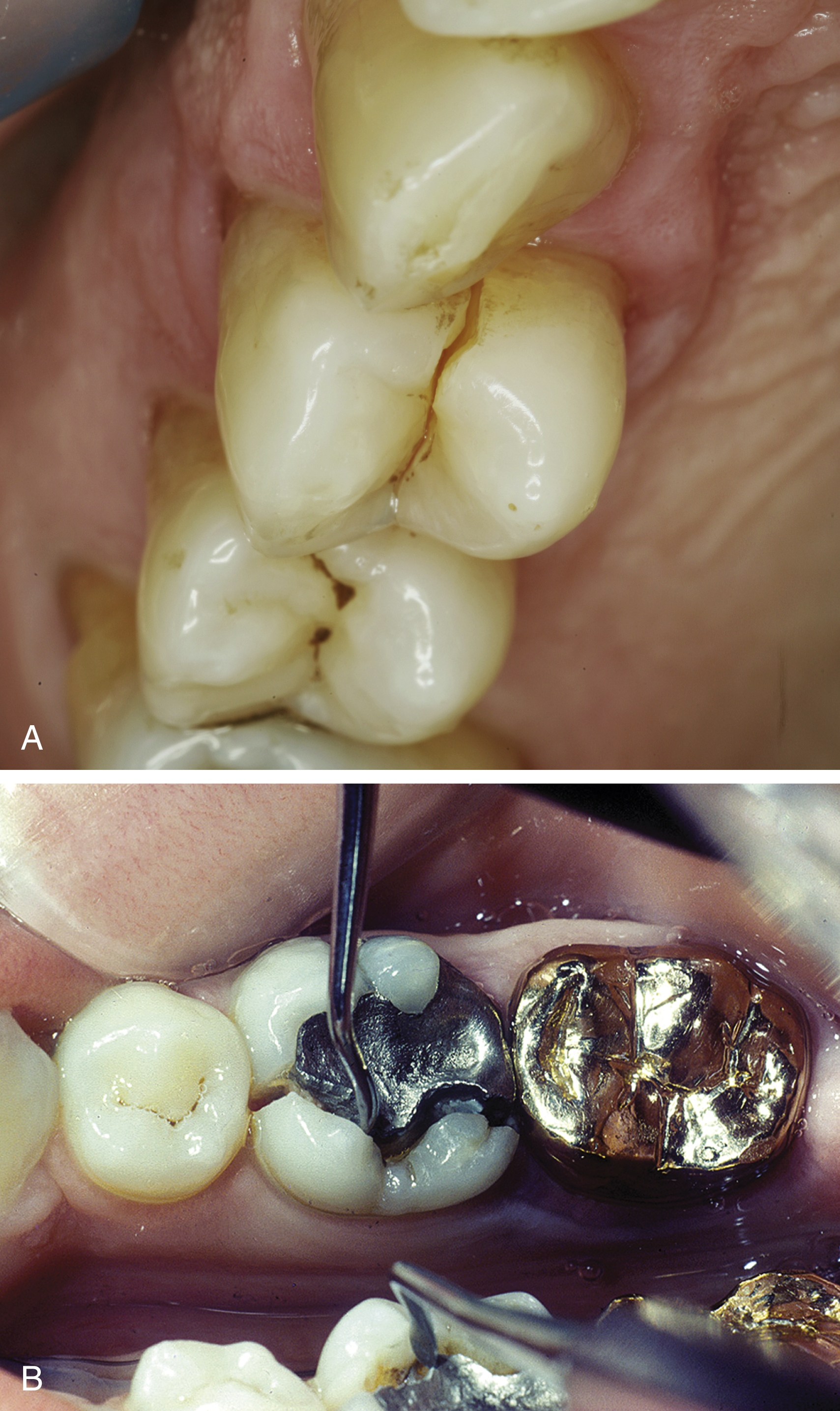 Restoration Of Endodontically Treated Teeth | Pocket Dentistry