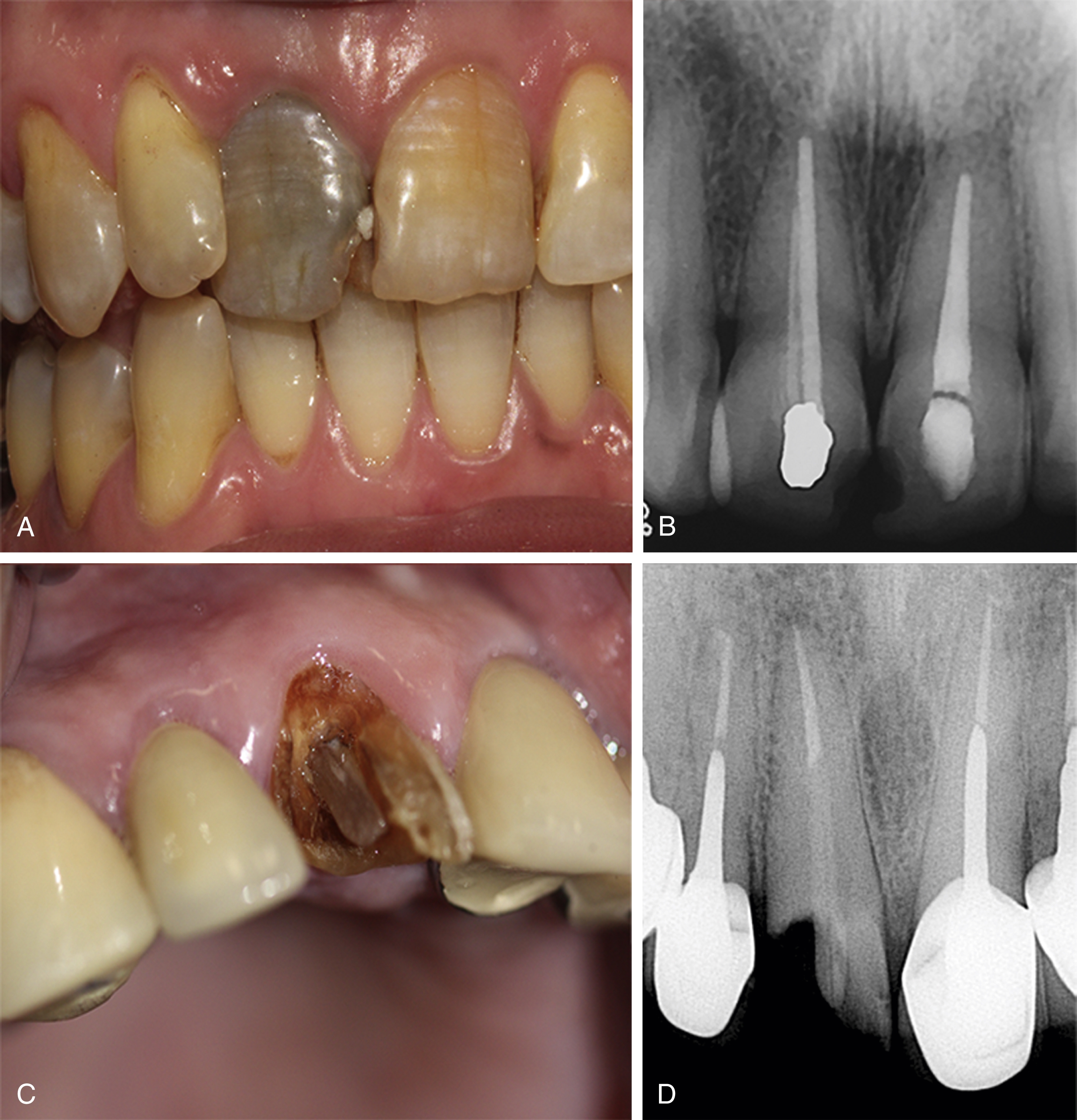 Nonsurgical Retreatment | Pocket Dentistry