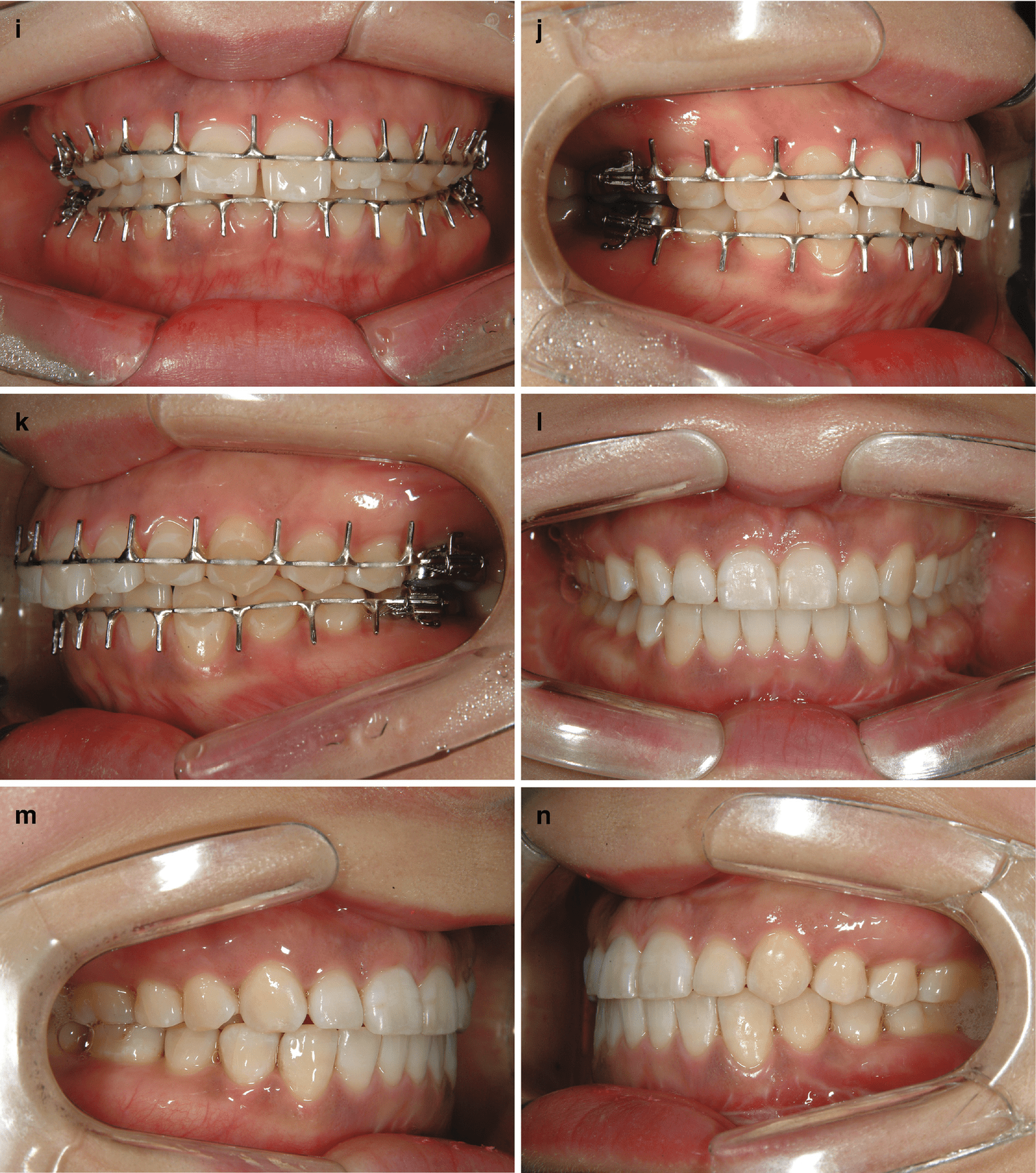 Follow-up Following The Surgery-First Approach | Pocket Dentistry