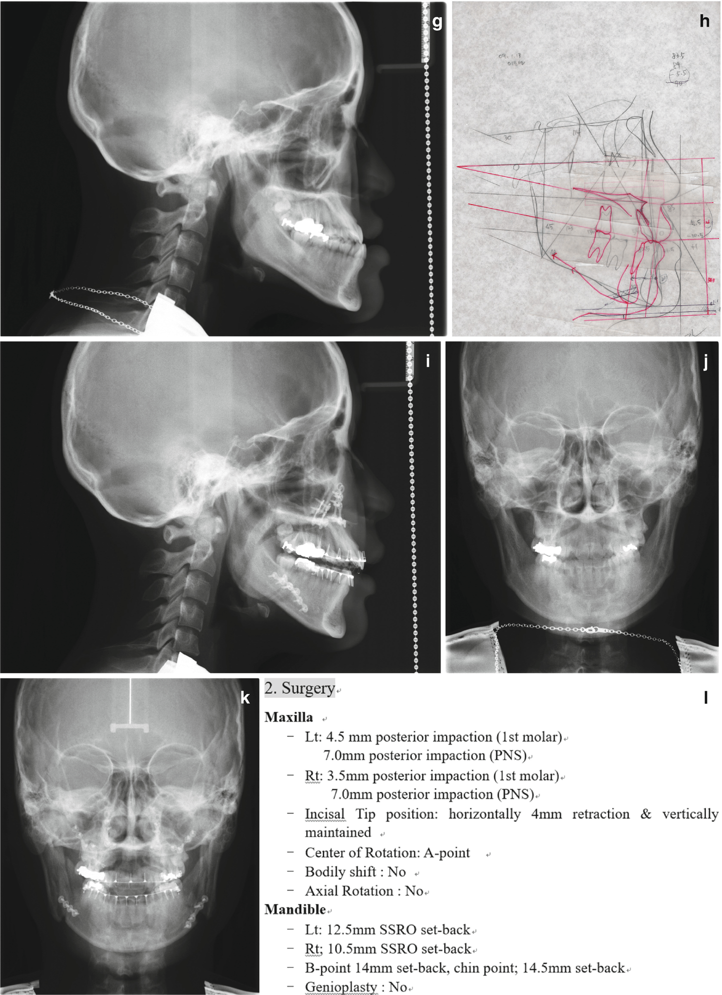 Follow-up Following The Surgery-First Approach | Pocket Dentistry