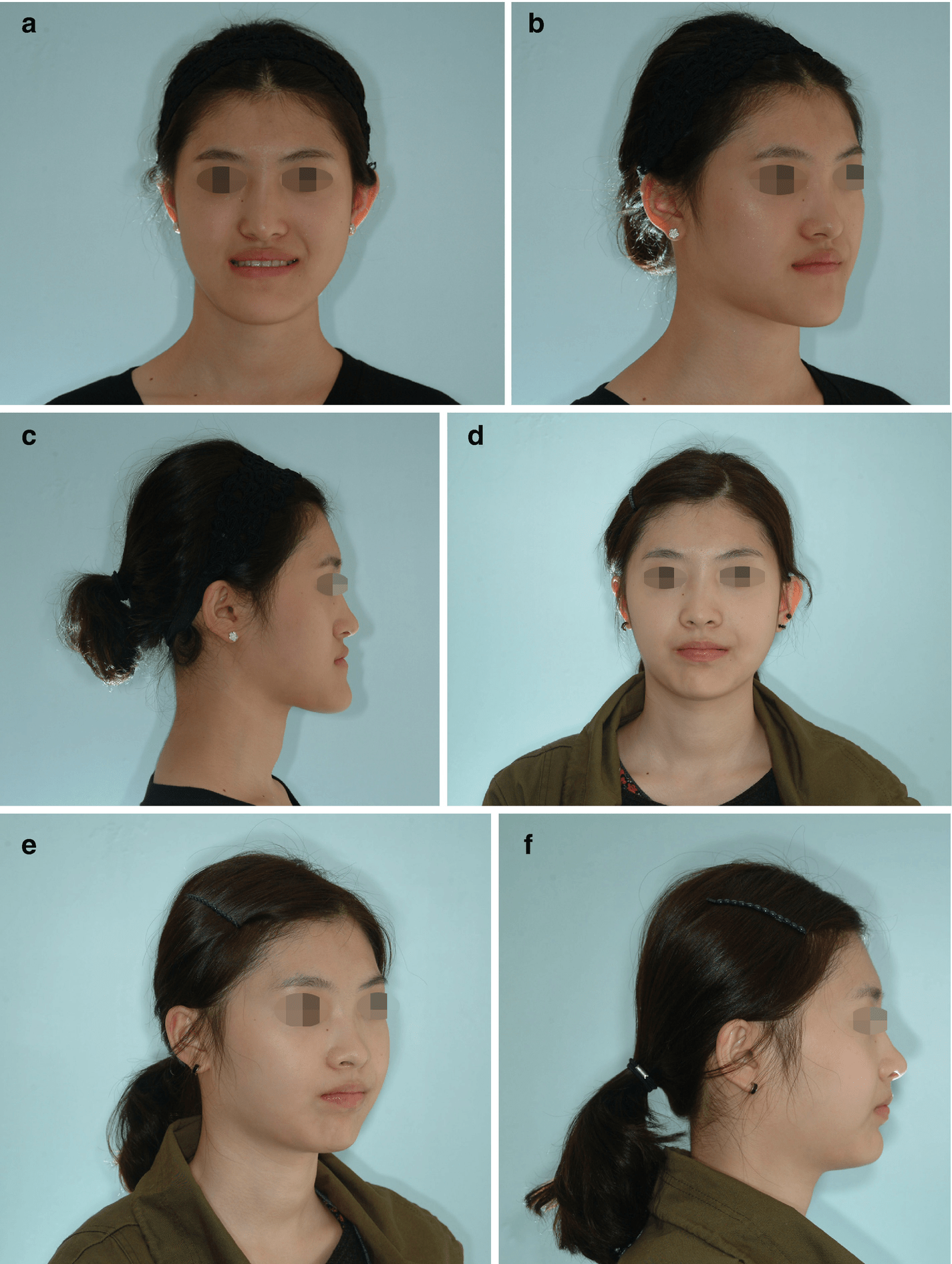 Treatment Time In The Surgery-First Orthognathic Approach | Pocket ...