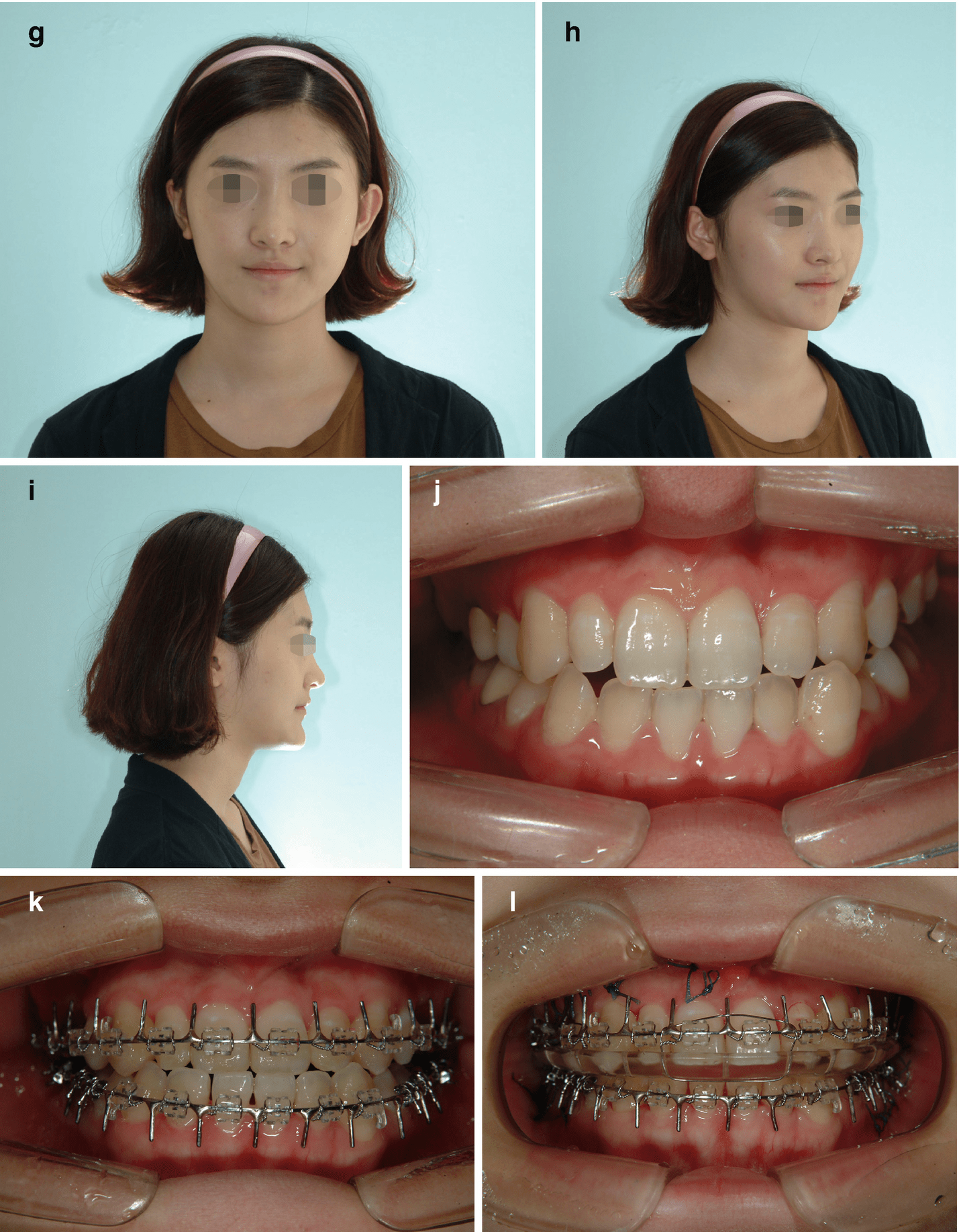 Treatment Time In The Surgery-First Orthognathic Approach | Pocket ...