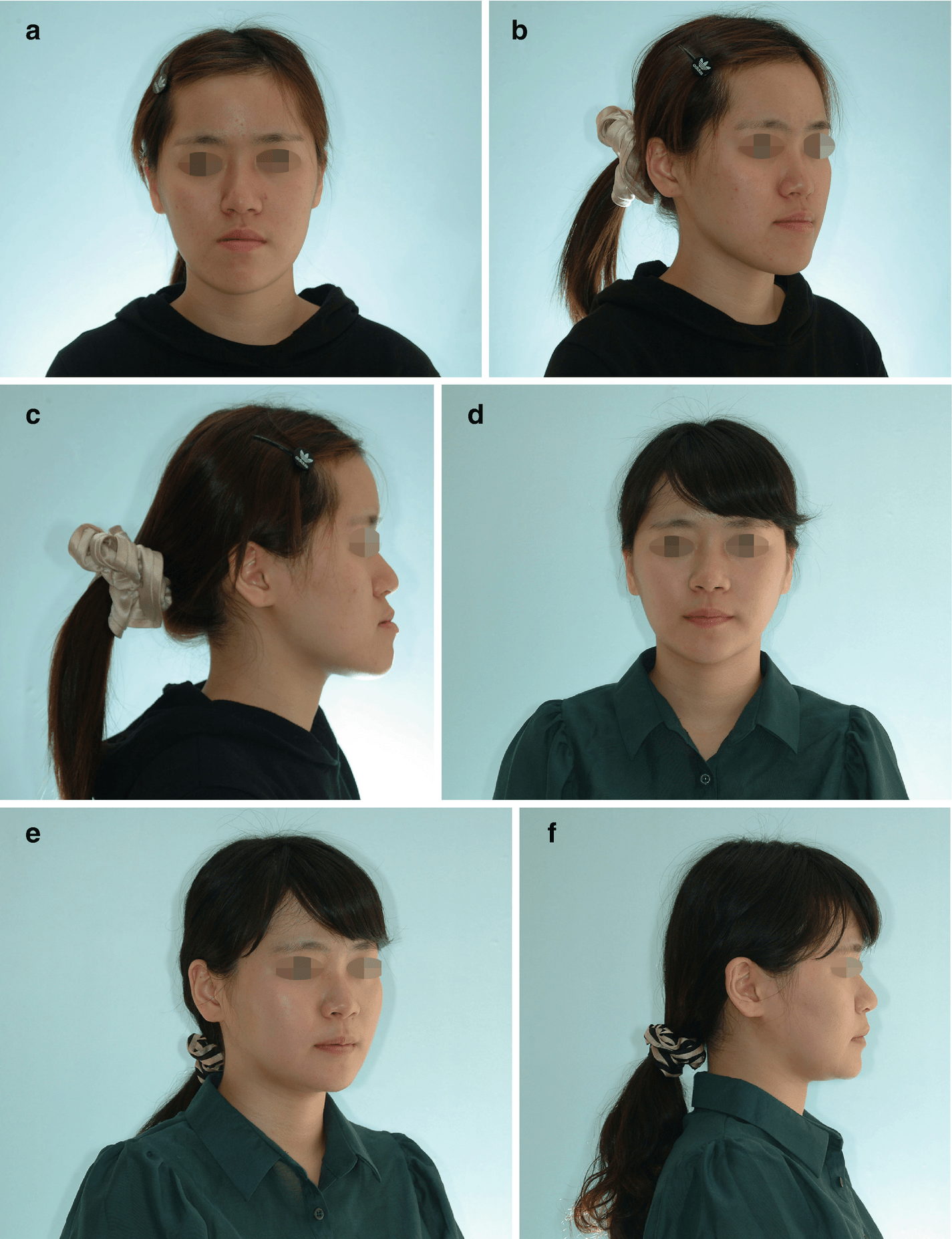 Treatment Time In The Surgery-First Orthognathic Approach | Pocket ...