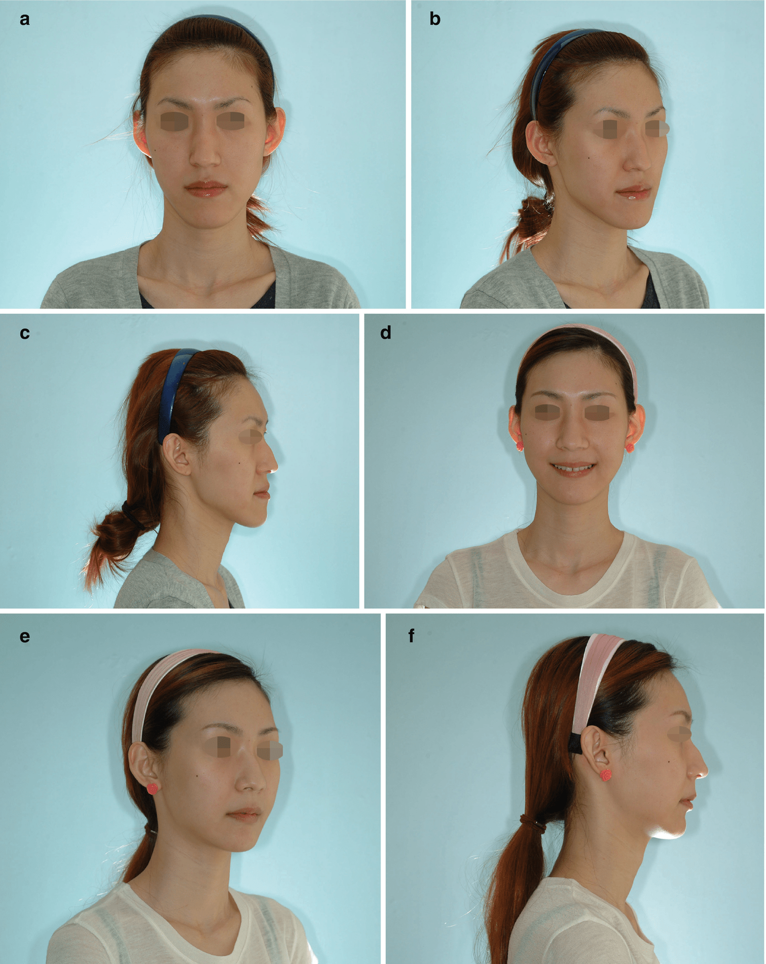 Treatment Time In The Surgery-First Orthognathic Approach | Pocket ...