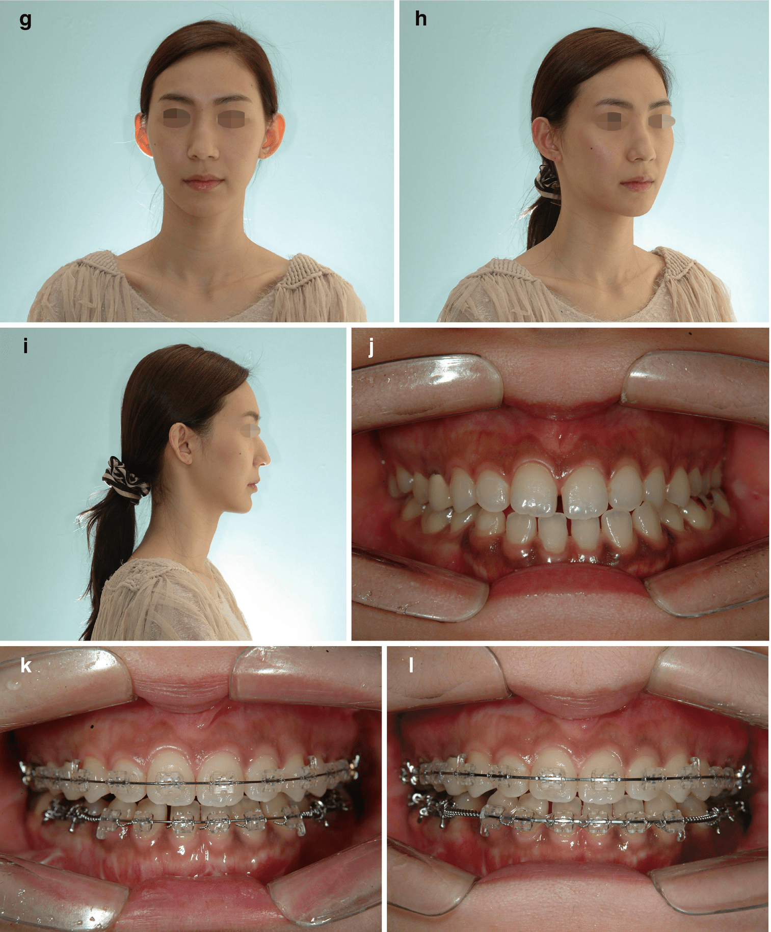 Treatment Time In The Surgery-First Orthognathic Approach | Pocket ...