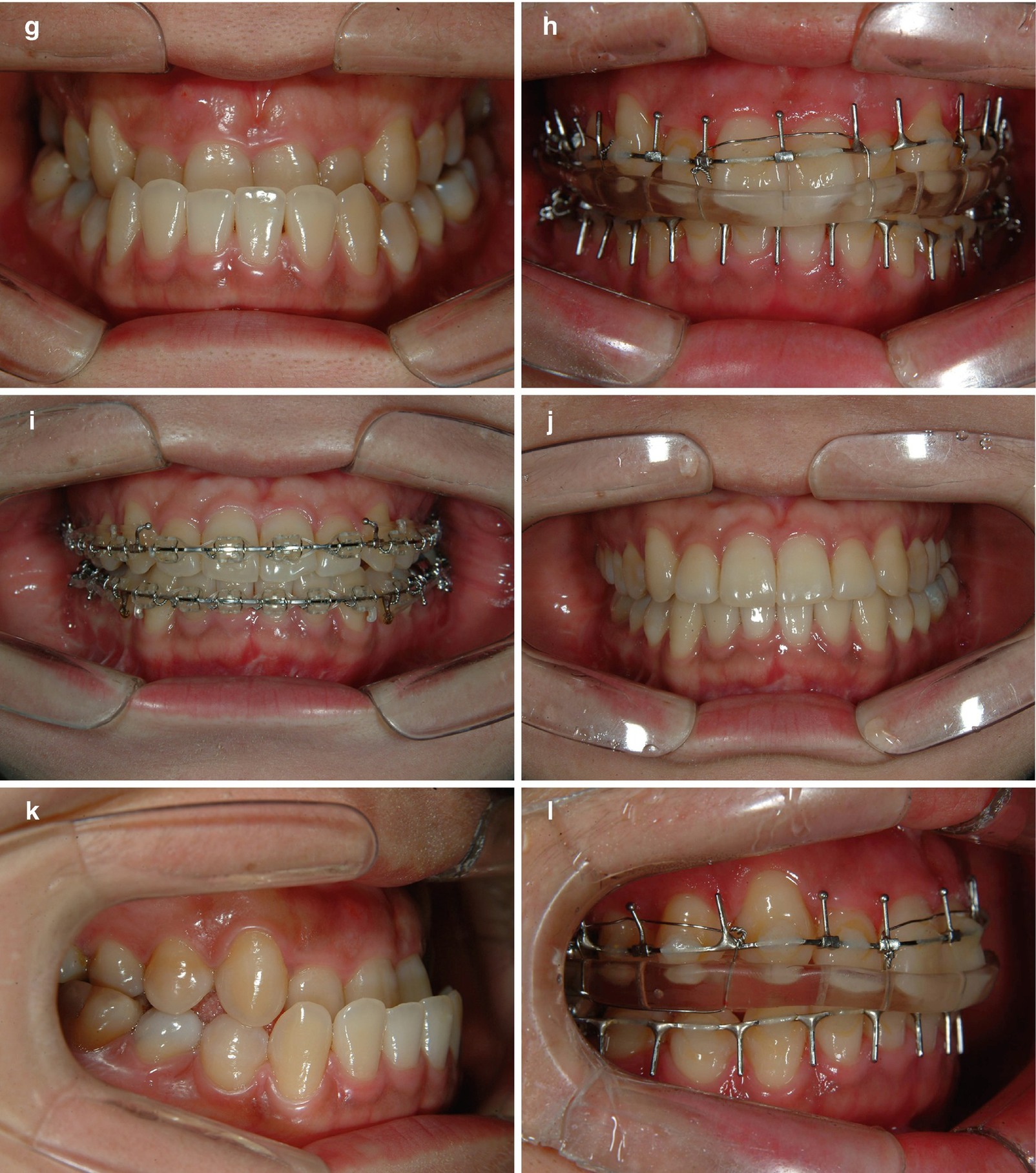 Treatment Time In The Surgery-First Orthognathic Approach | Pocket ...