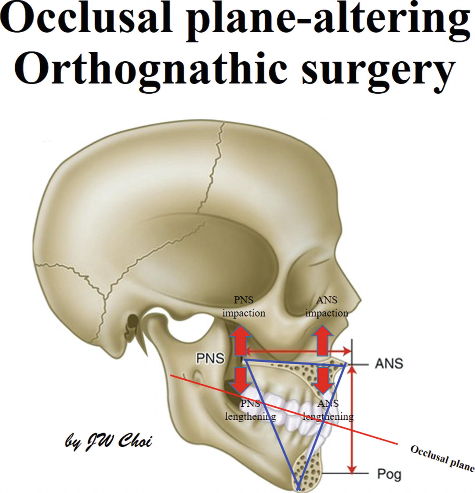 Plane-Altering Orthognathic Surgery (Jaw Rotational Orthognathic ...