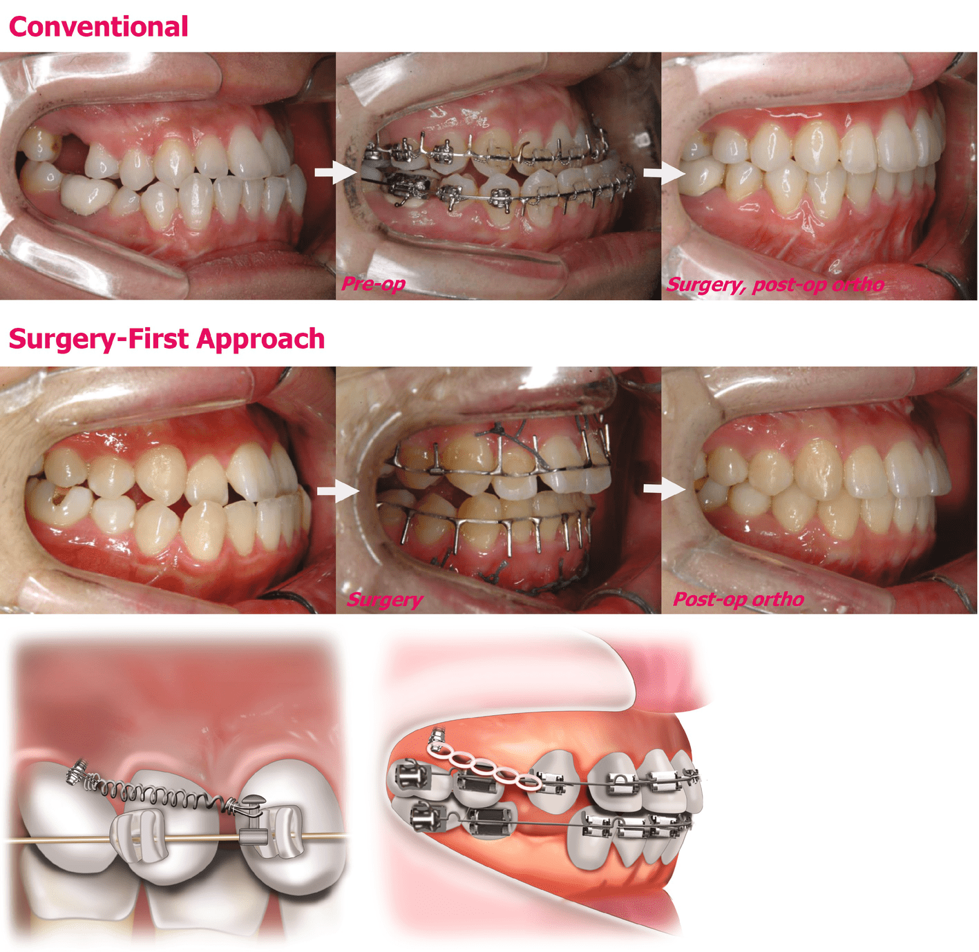 And Evolution Of The Surgery-First Approach | Pocket Dentistry