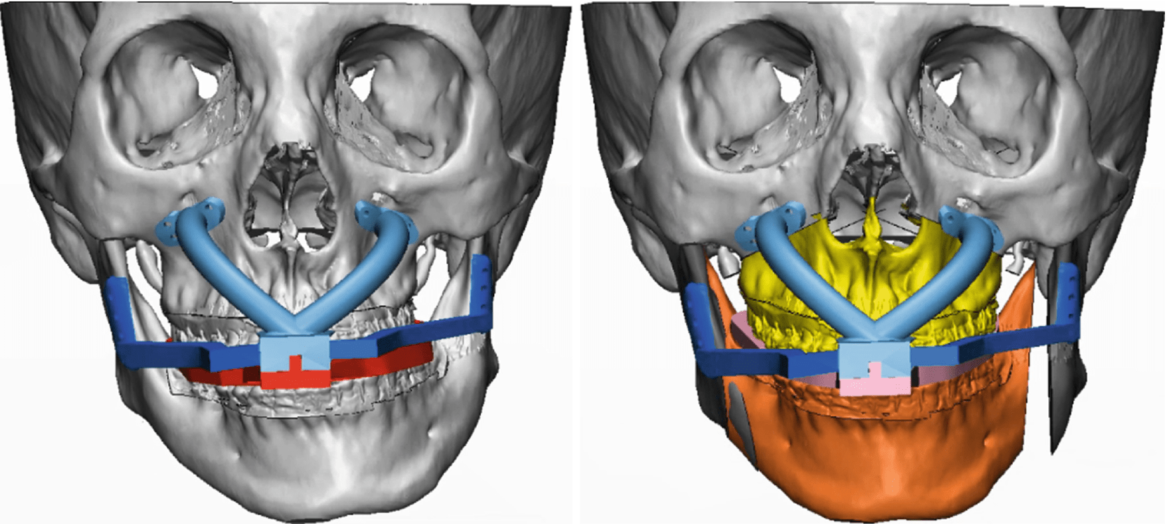 Surgical Planning And Three-Dimensional Simulation In Orthognathic ...