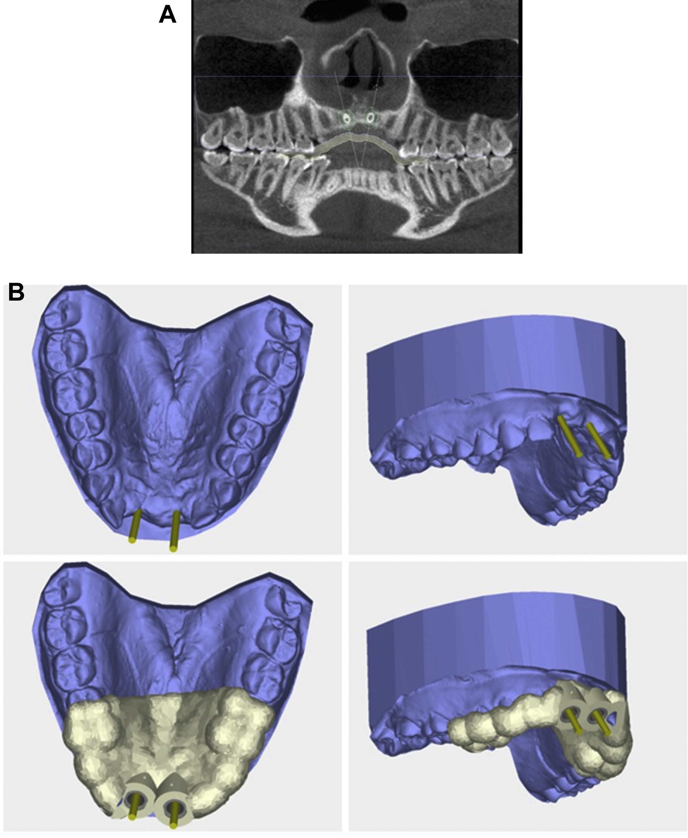 Prosthodontic Principles In Dental Implantology | Pocket Dentistry