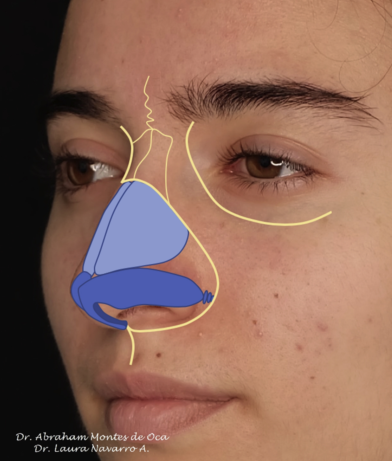 Preservation Rhinoplasty For The Dorsum And Tip | Pocket Dentistry