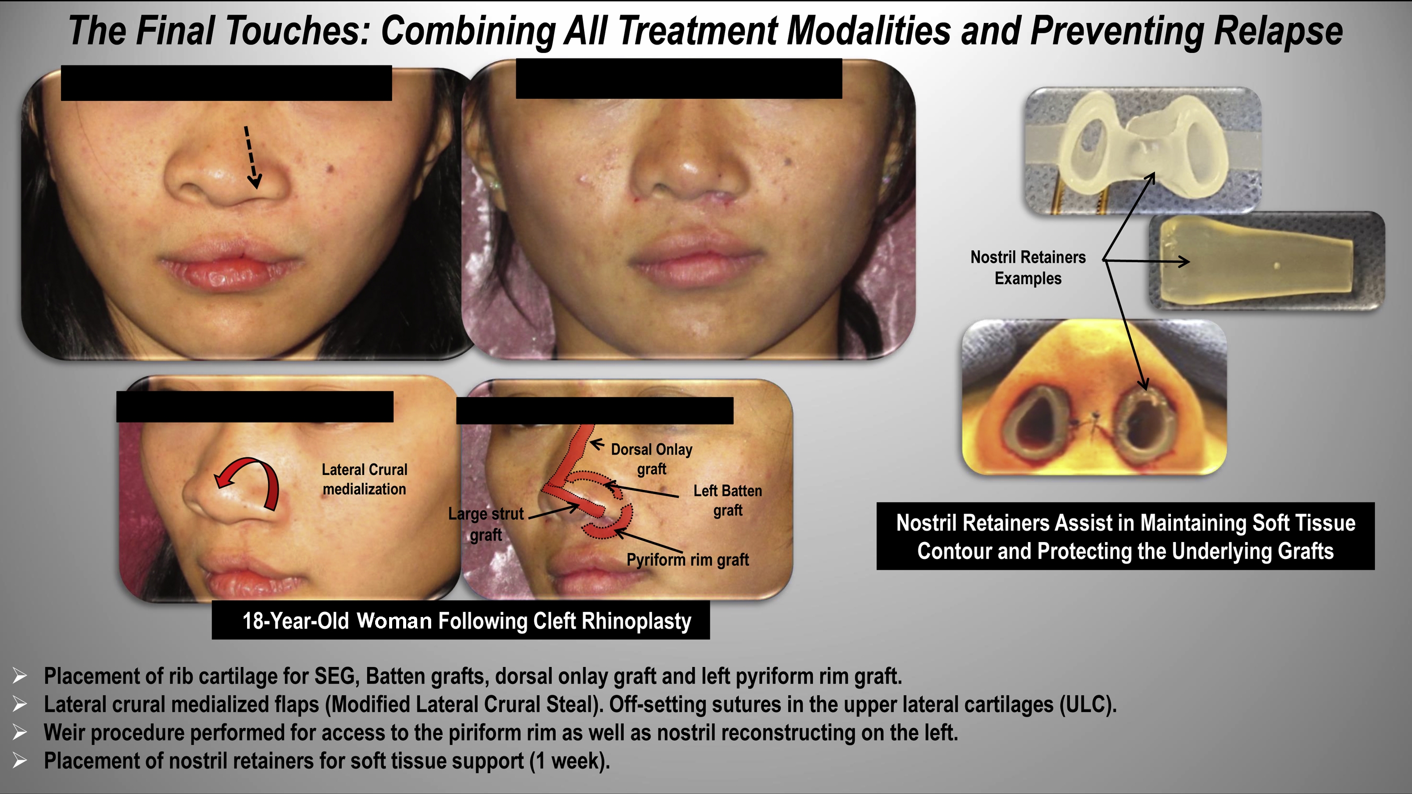 Challenging Rhinoplasty For The Cleft Lip And Palate Patient | Pocket ...