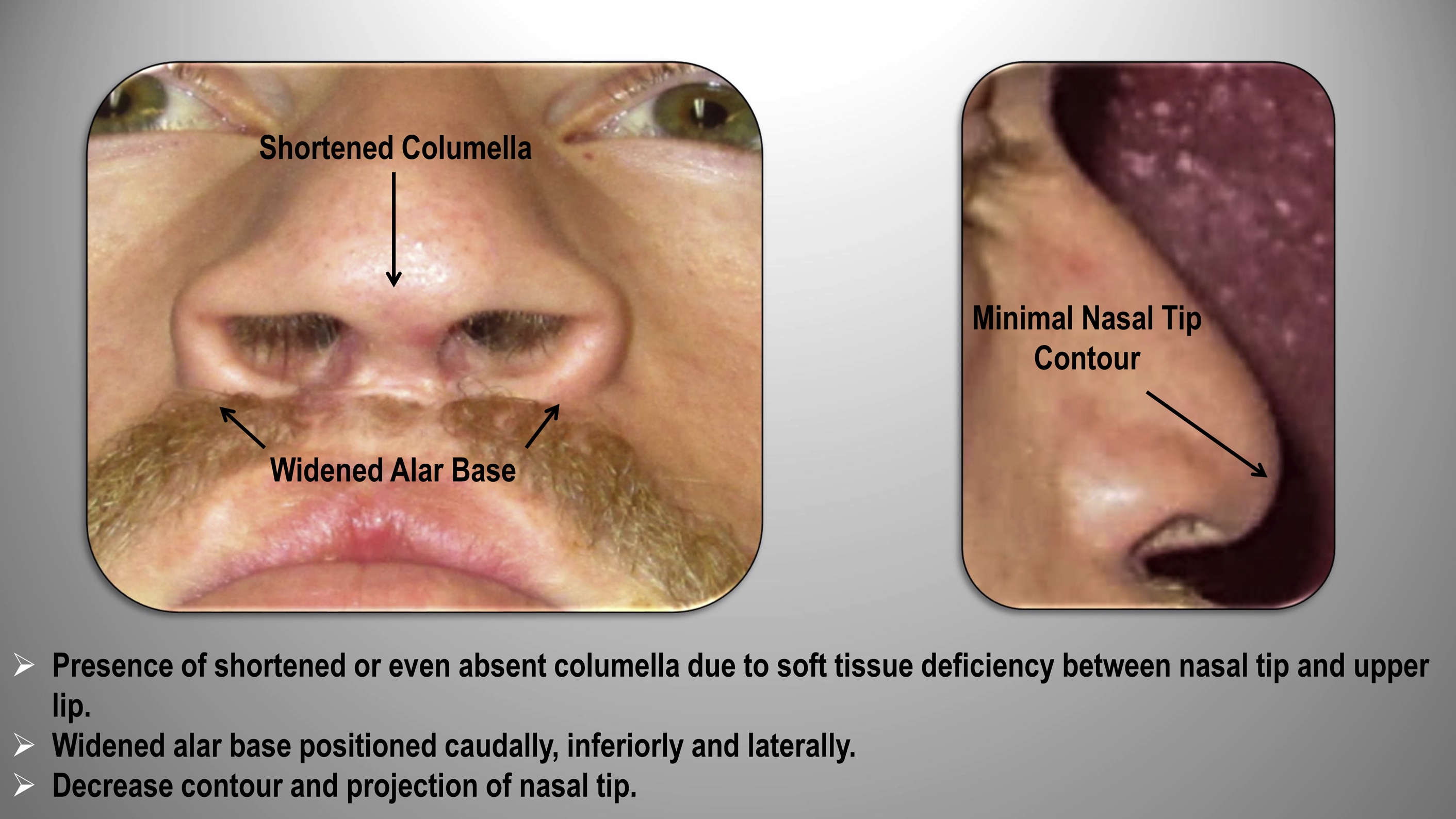 Challenging Rhinoplasty For The Cleft Lip And Palate Patient | Pocket ...