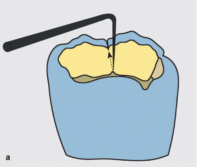 Occlusal Modeling | Pocket Dentistry