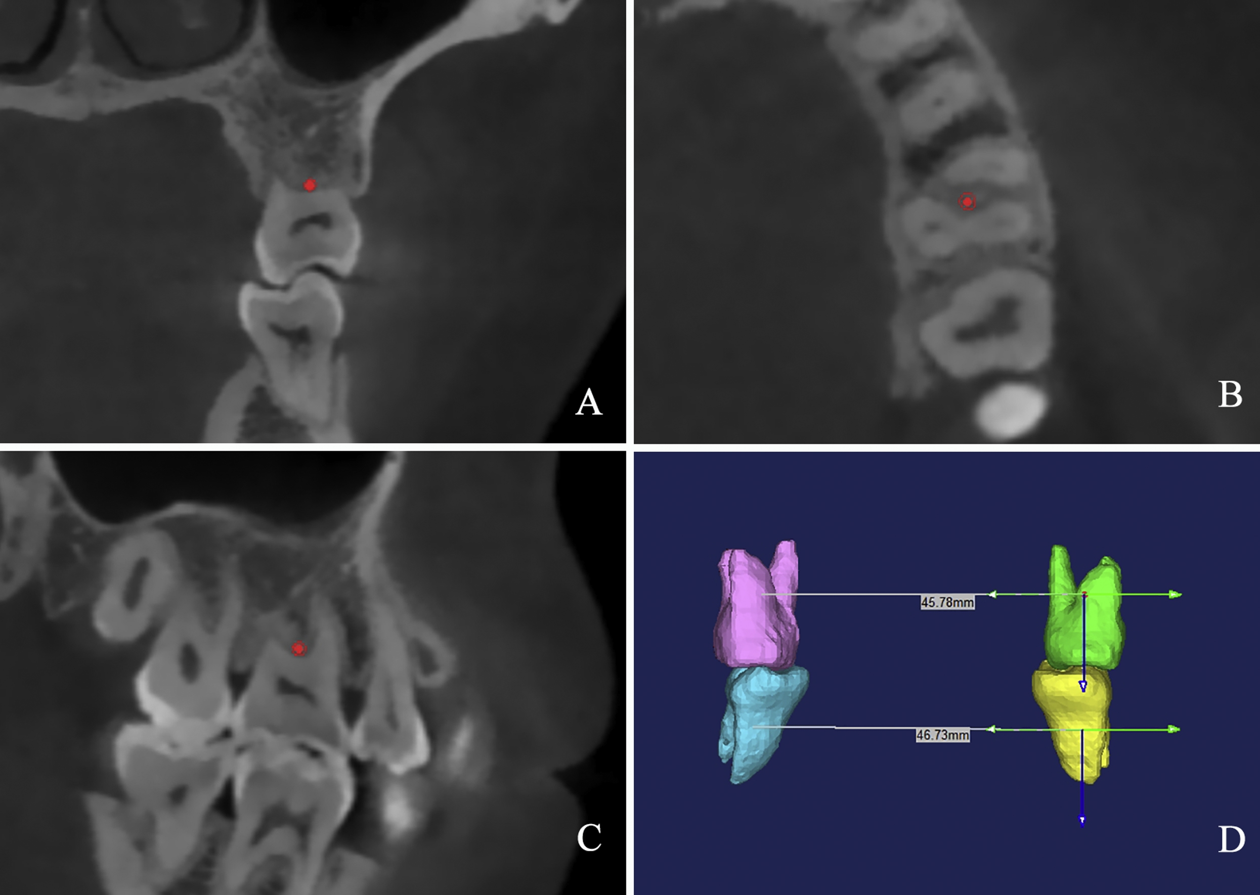 Reliability Of 2 Methods In Maxillary Transverse Deficiency Diagnosis ...