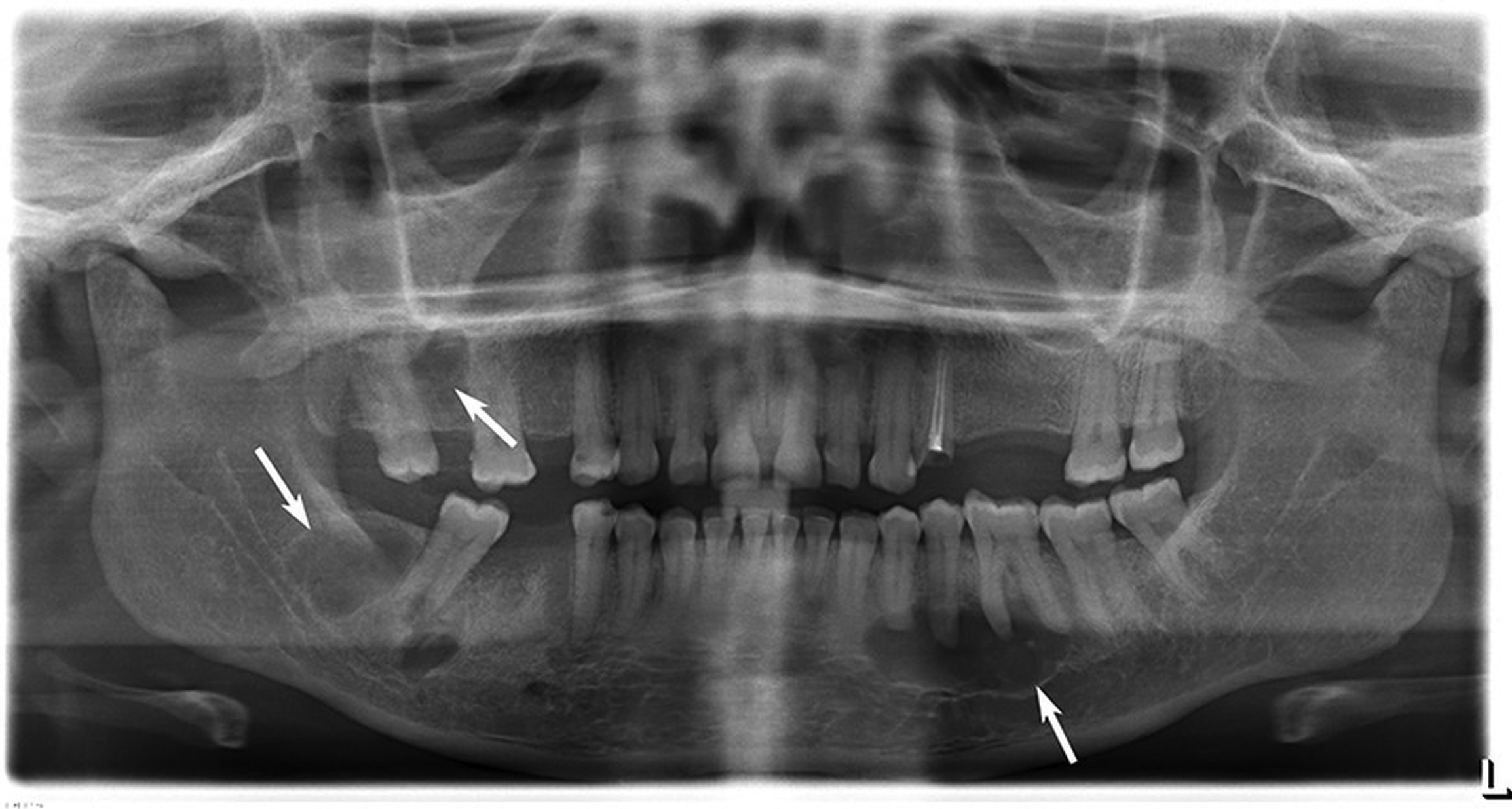 Radiographic Diagnosis Of Systemic Diseases Manifested In Jaws | Pocket ...