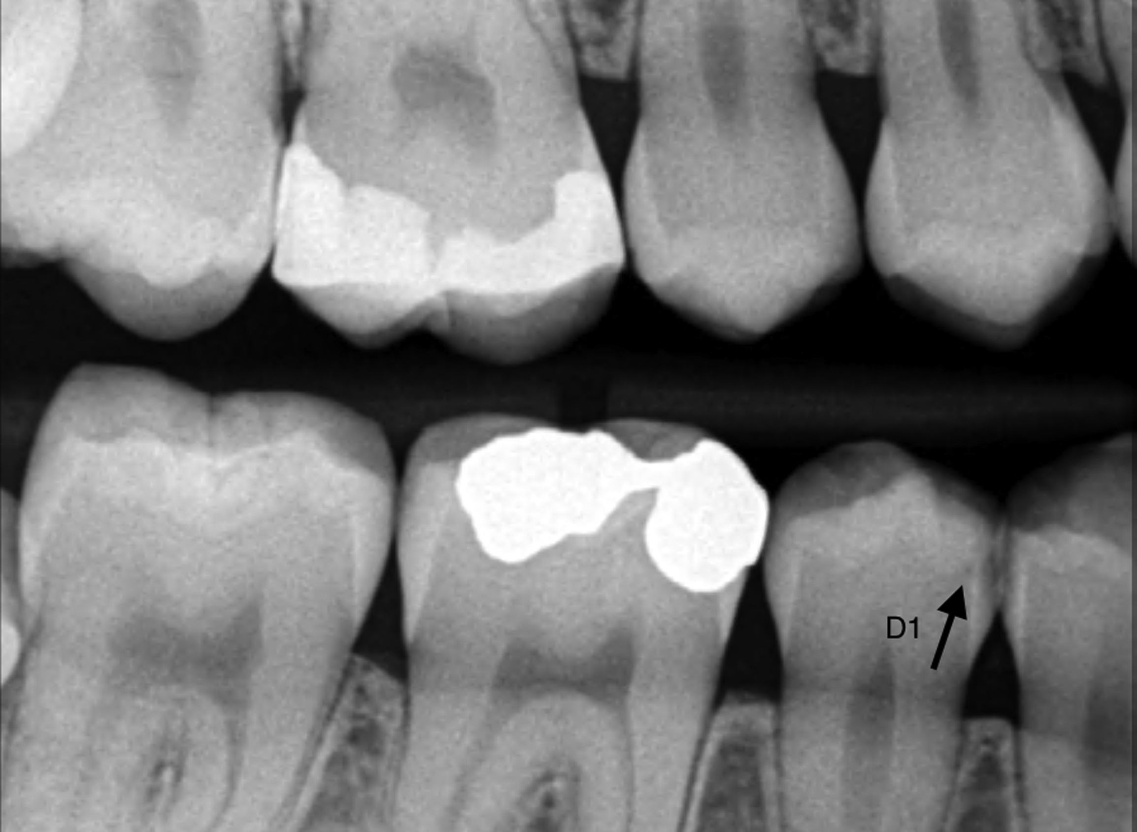 Radiology Of Dental Caries | Pocket Dentistry