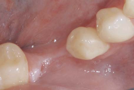 The Titanium-base Abutment Concept | Pocket Dentistry