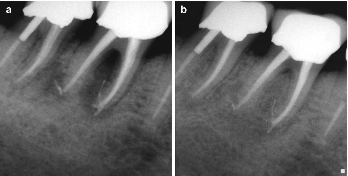 Of Endodontic-Periodontic Lesions | Pocket Dentistry