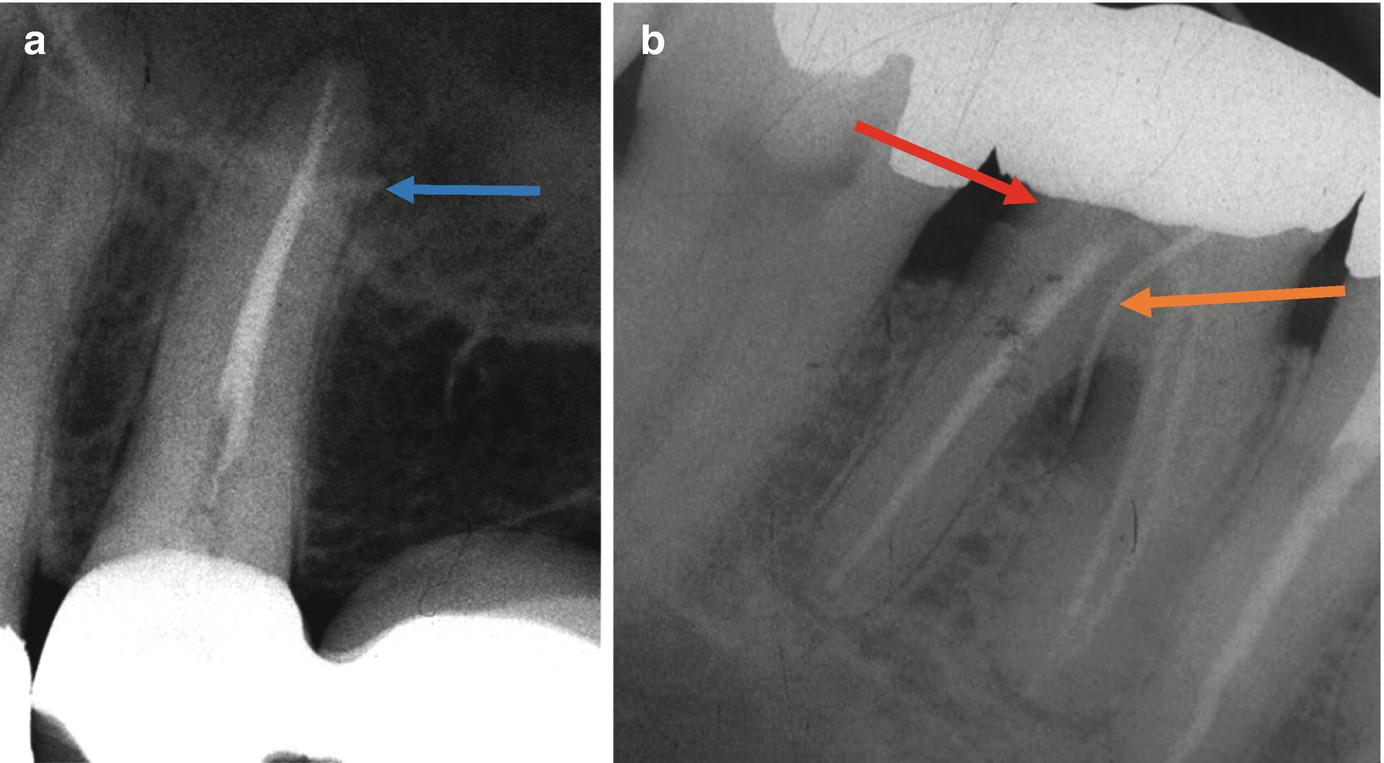 Of Endodontic-Periodontic Lesions | Pocket Dentistry