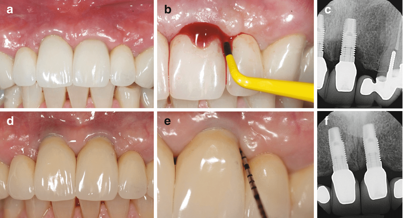 In Periodontal Surgery | Pocket Dentistry