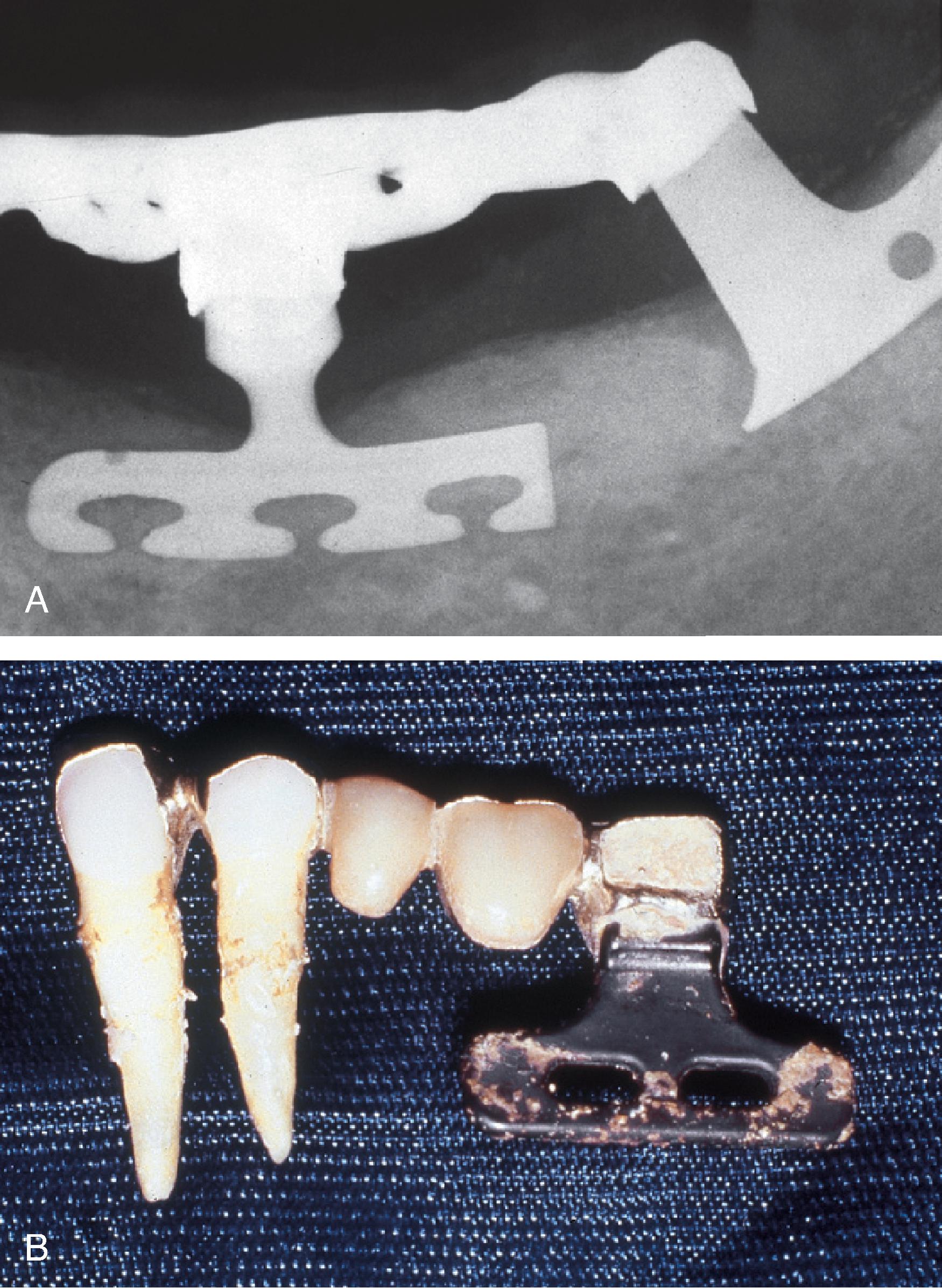 Dental Implants | Pocket Dentistry