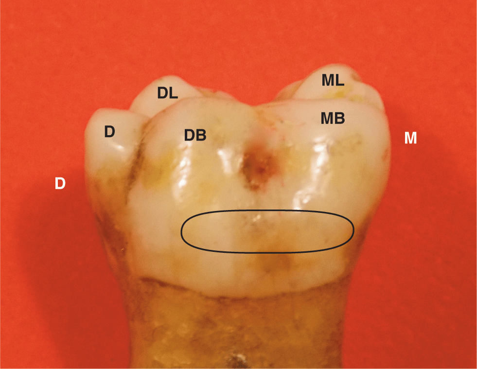 Type Traits That Differentiate Mandibular Second From First Molars ...