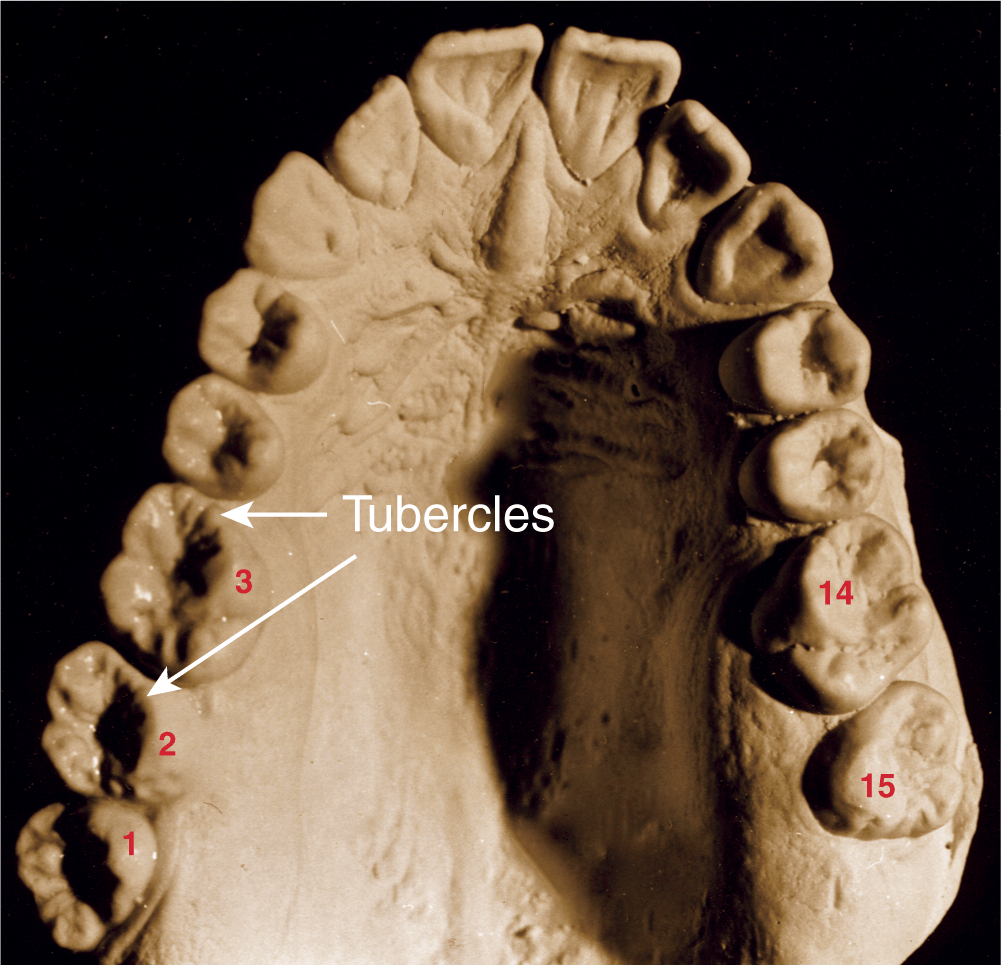 Type Traits That Differentiate Maxillary Second From First Molars ...