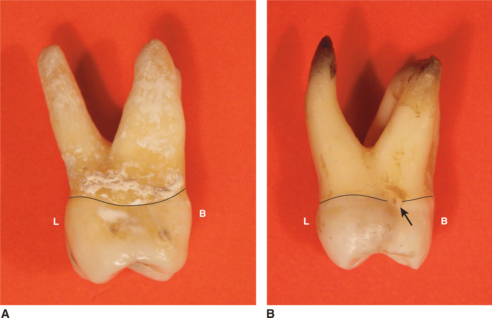 Type Traits That Differentiate Maxillary Second From First Molars ...