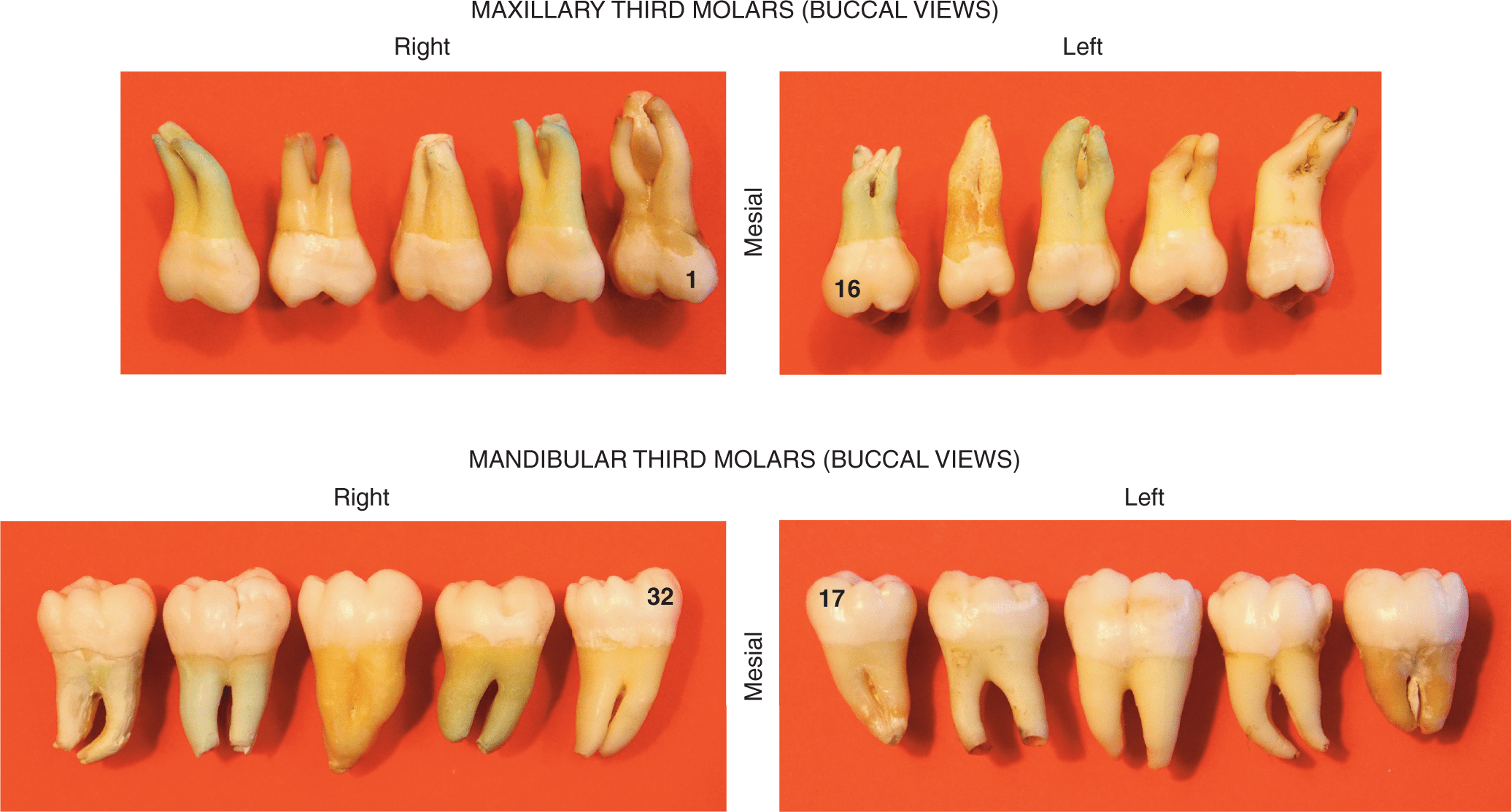 Maxillary And Mandibular Third Molar Type Traits | Pocket Dentistry