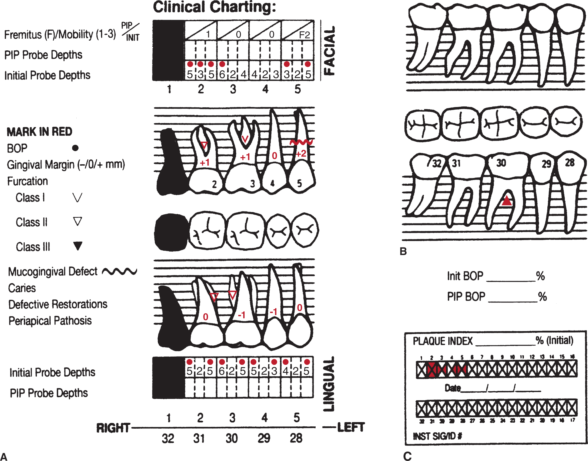 Psr Periodontal Chart