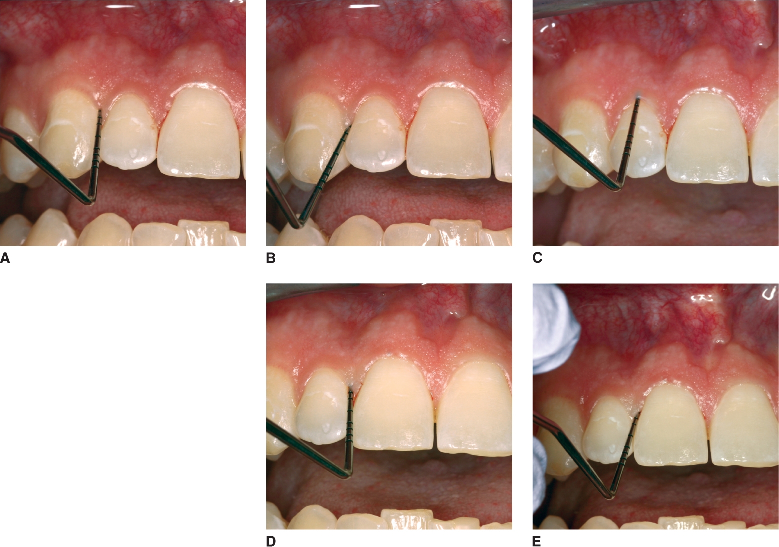 Periodontal Measurements: Indicators Of Disease And Conditions | Pocket ...