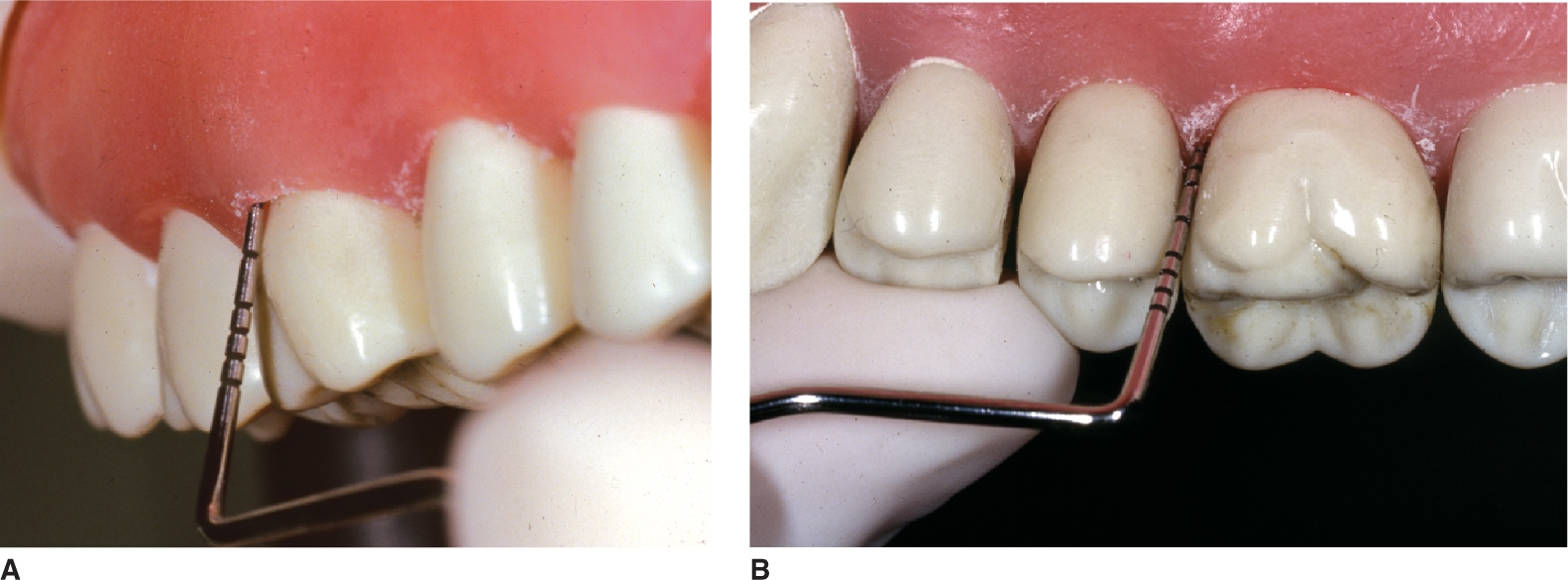 Periodontal Measurements: Indicators Of Disease And Conditions | Pocket ...