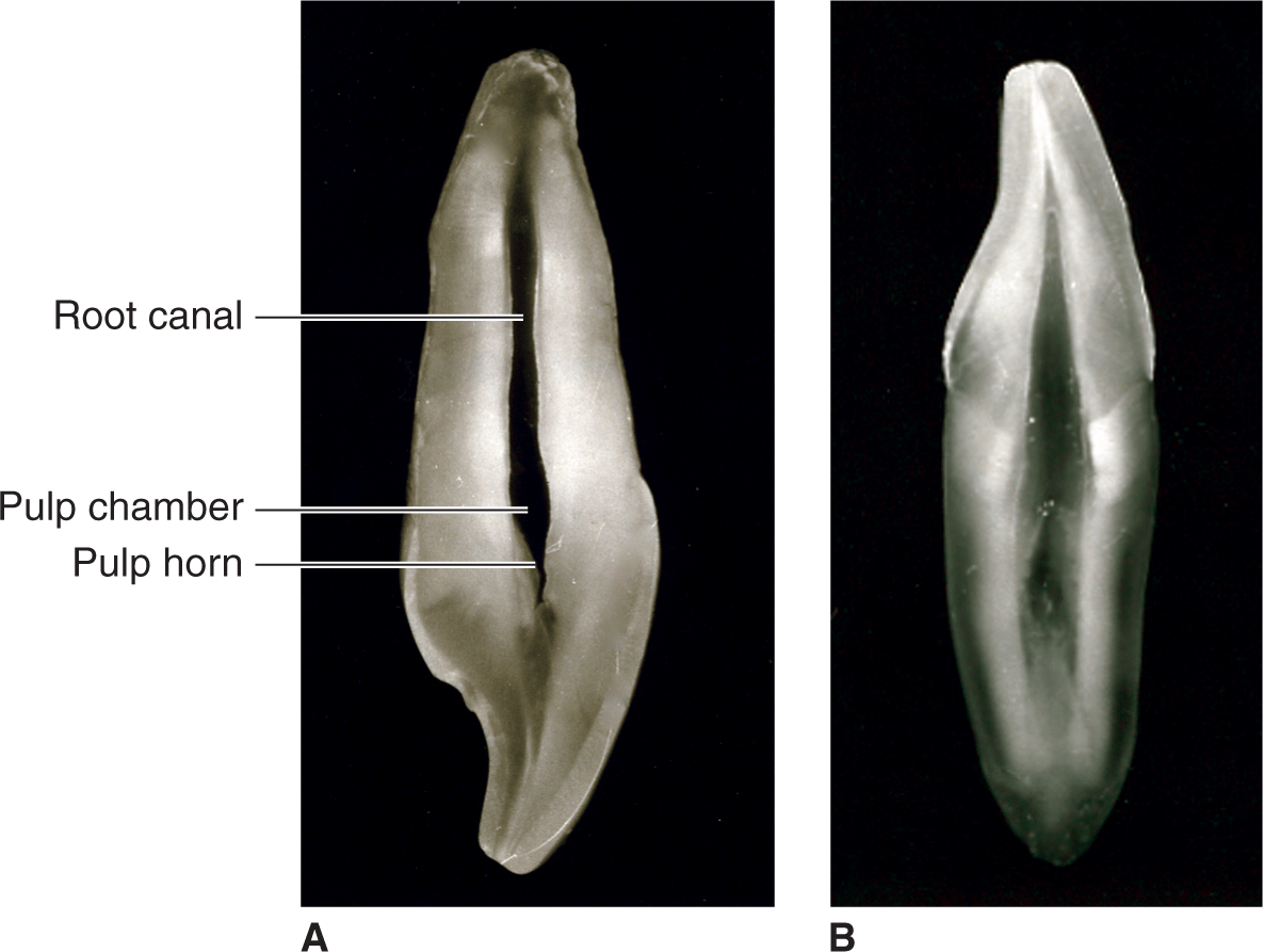 Internal Pulp Cavity Morphology Related To Endodontic And Restorative ...