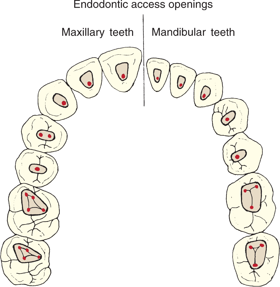 Internal Pulp Cavity Morphology Related To Endodontic And Restorative ...