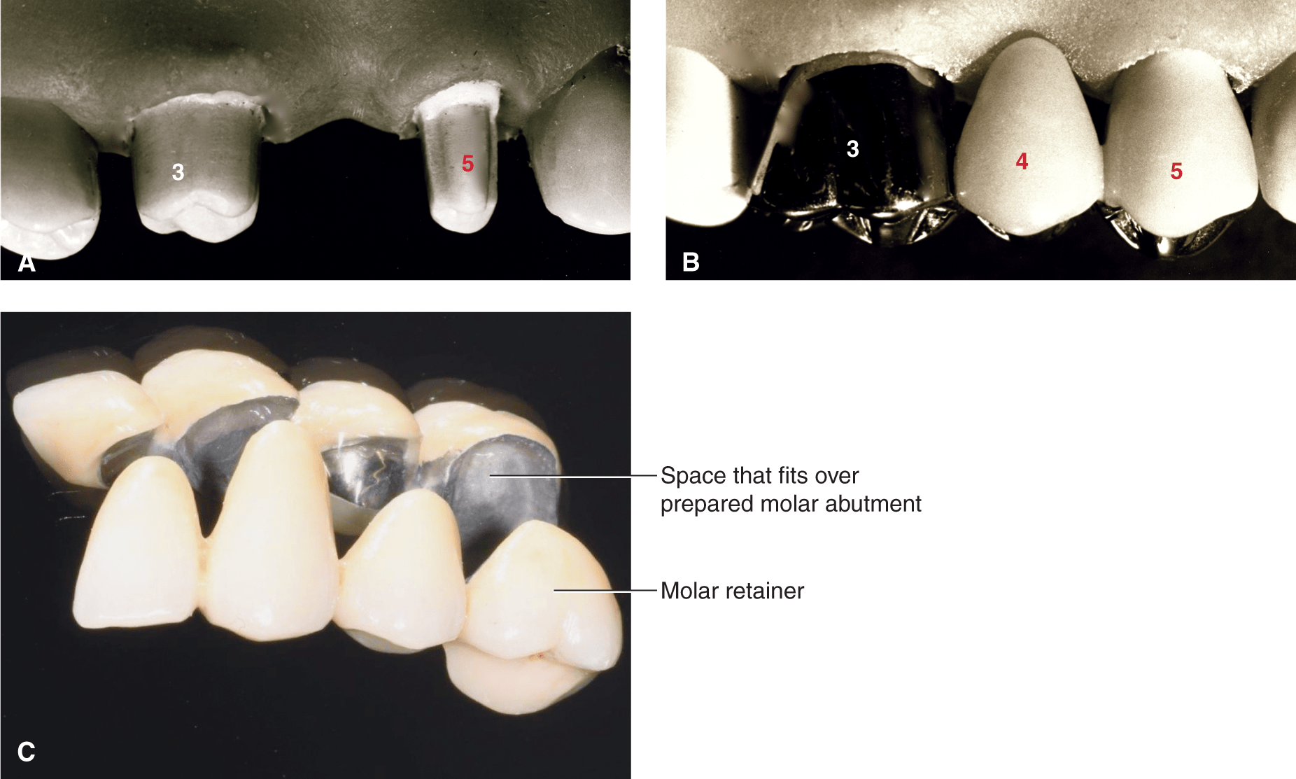 Restoring Large Tooth Defects And Tooth Replacement | Pocket Dentistry