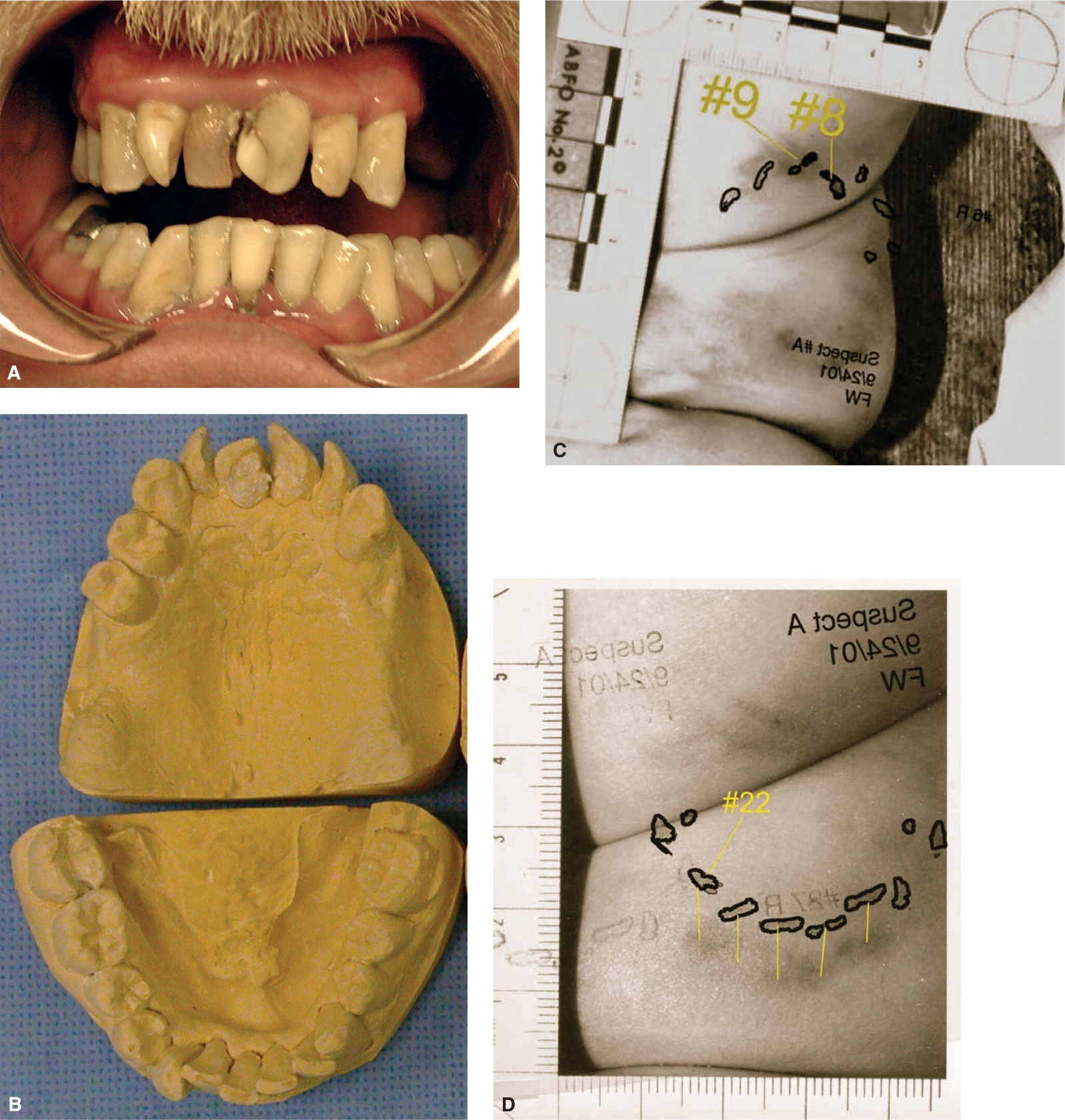 Bite Marks | Pocket Dentistry