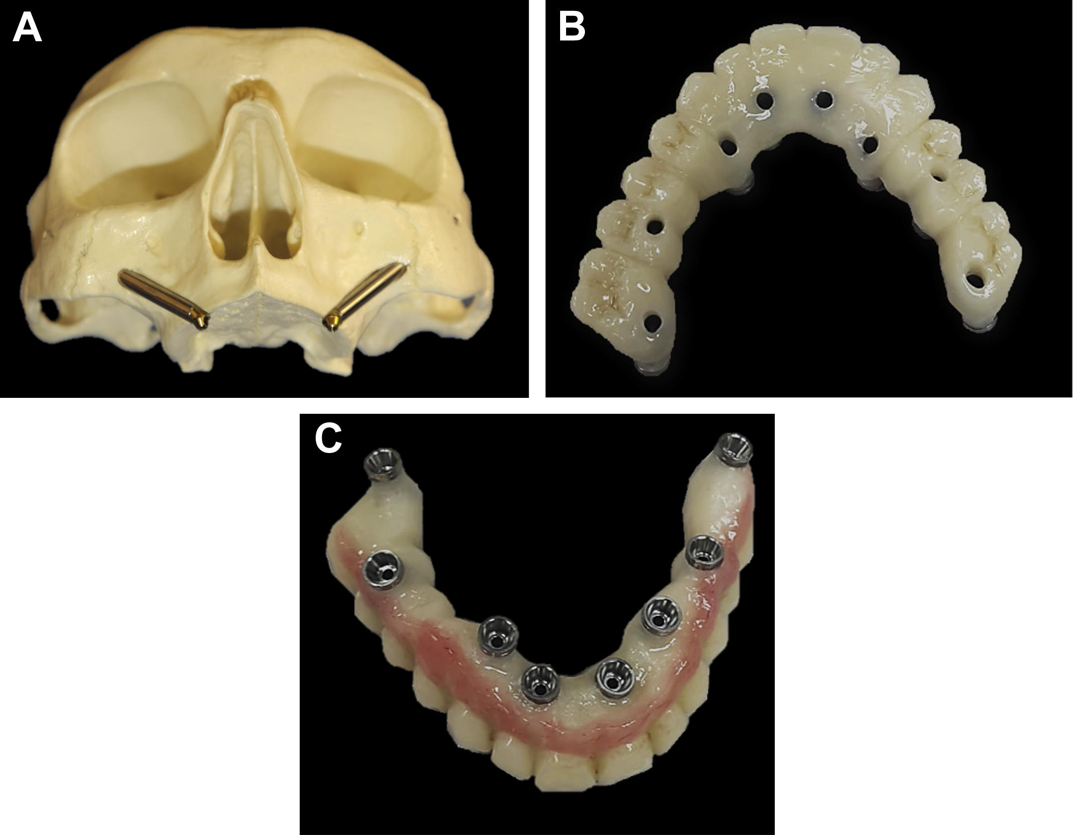 Zygomatic Implants | Pocket Dentistry