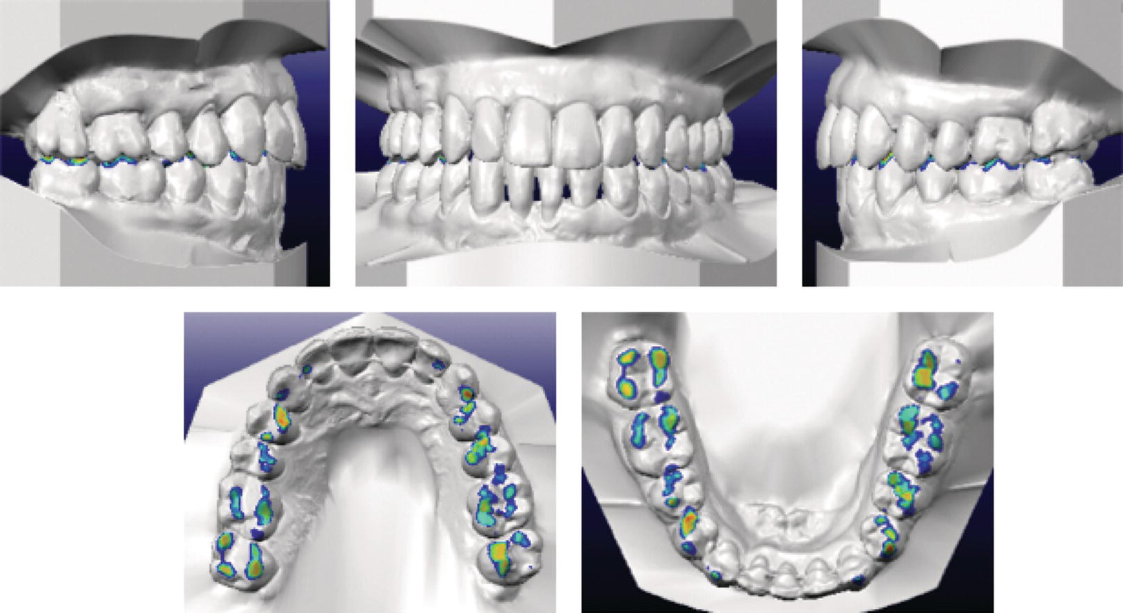 Extraction Cases | Pocket Dentistry