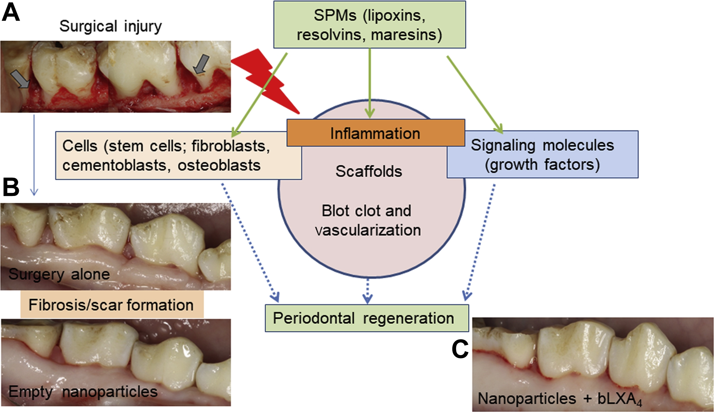 Inflammation And Periodontal Regeneration | Pocket Dentistry